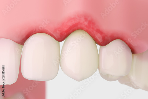 фотографія Gingival recession showing exposed tooth roots and receding gums.