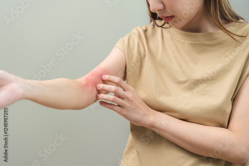 фотографія Dermatology asian young woman, girl allergy, allergic reaction from atopic, insect bites on her arm, hand in scratching itchy, itch red spot or rash of skin