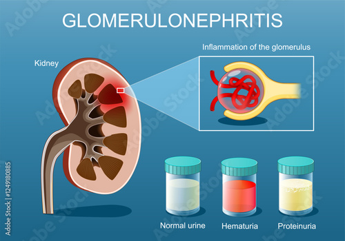 Glomerulonephritis. kidney, glomerulus Inflammation.