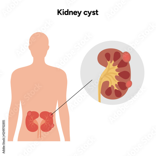 Kidney cysts polycystic urinary disease. Renal cysts of fluid in the kidneys. Medical diagram illustration 