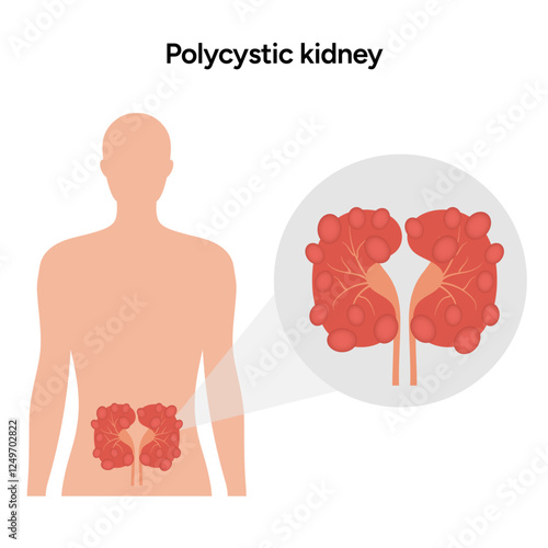 Kidney cysts polycystic urinary disease. Renal cysts of fluid in the kidneys. Medical diagram illustration 