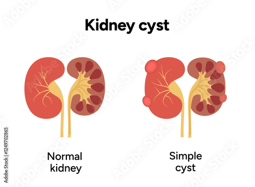Kidney cysts polycystic urinary disease. Renal cysts of fluid in the kidneys. Medical diagram illustration 