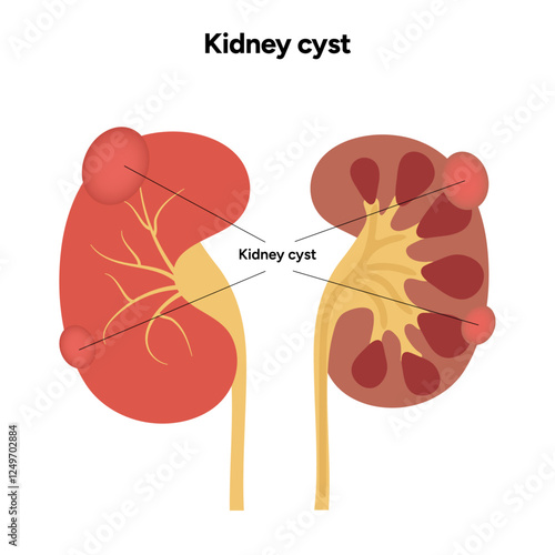 Kidney cysts polycystic urinary disease. Renal cysts of fluid in the kidneys. Medical diagram illustration 