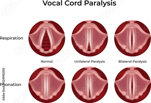 Vocal Cord Paralysis Normal vs Affected Design Vector Illustration