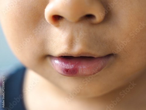 Close-up of a child with bleeding lips due to accident, Lip care.
