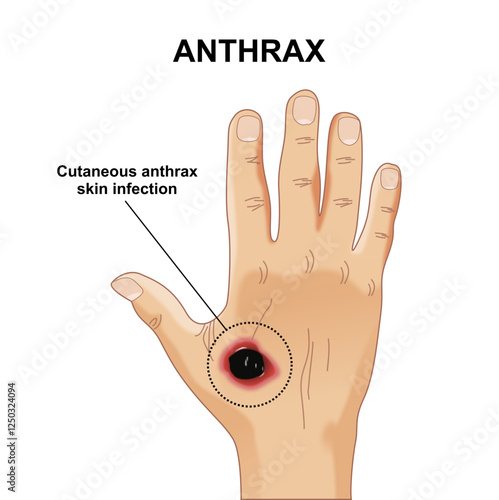 Anthrax skin infection illustration of hand