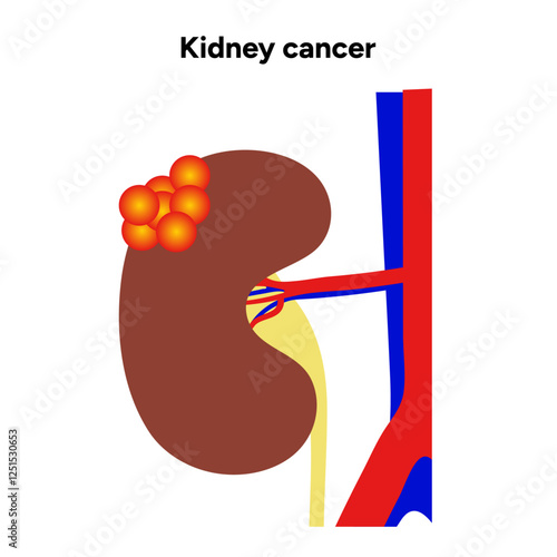 Kidney cancer disease Process in human. Medical problem Diagram