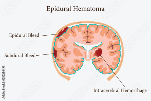 Labeled brain cross-section illustrating intracranial bleeding from traumatic head injury