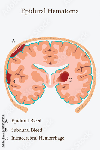 Epidural hematoma medical infographic illustrating different brain hemorrhage locations.