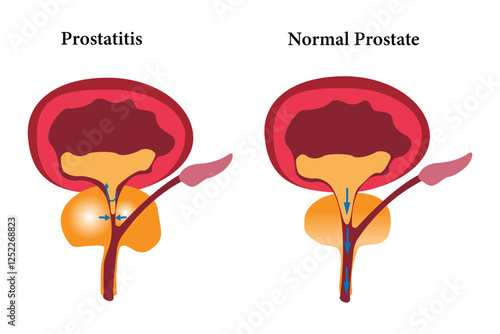 Prostatitis vs. normal prostate infographic highlighting swelling and urination issues.