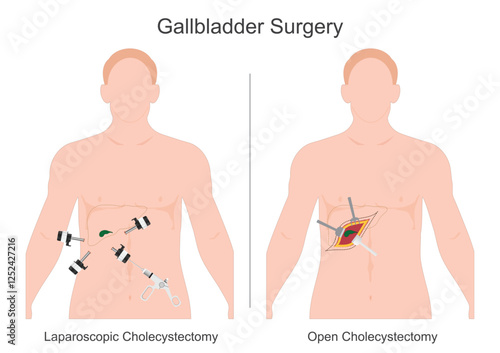 A Cholecystectomy is surgery to remove gallbladder.