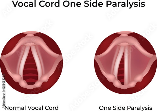 Vocal Cord Paralysis One Side Design Vector Illustration