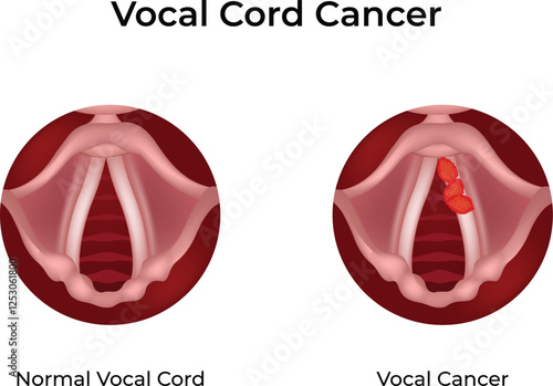 Vocal Cord Cancer Design Vector Illustration