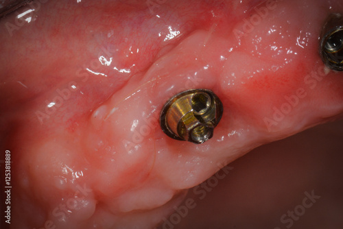 Papier peint dental implant multi-uniit abutment healthy peri-implant tissue