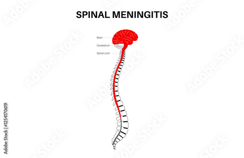 Spinal meningitis poster