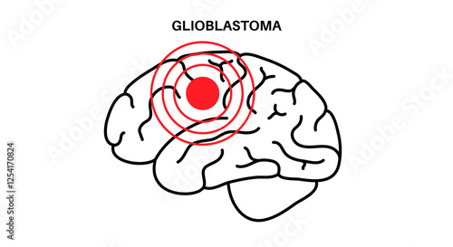 Glioblastoma brain cancer