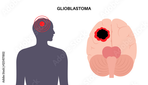 Glioblastoma brain cancer