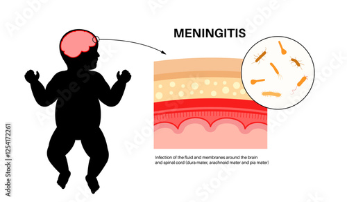 Meningitis medical poster