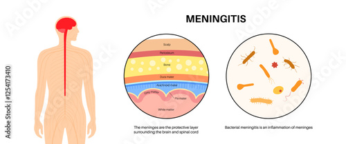 Meningitis medical poster