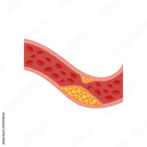 High Cholesterol, Cardiovascular Disease Illustration Icon