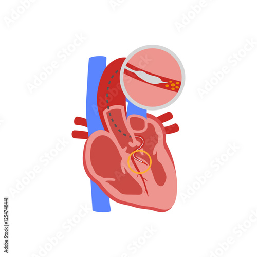 Alcohol Septal Ablation, Cardiovascular Disease Illustration Icon