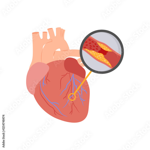 Myocardial Infarction, Cardiovascular Disease Illustration Icon