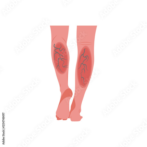 Chronic Venous Insufficiency, Cardiovascular Disease Illustration Icon