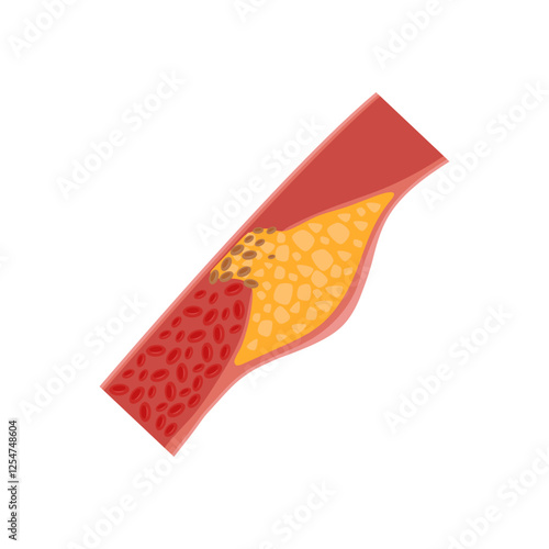 Clogged Artery, Cardiovascular Disease Illustration Icon