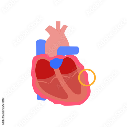 Pericarditis, Cardiovascular Disease Illustration Icon