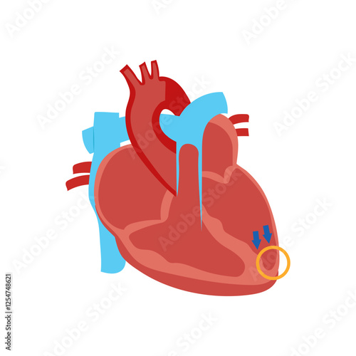 Dilated Cardiomyopathy, Cardiovascular Disease Illustration Icon