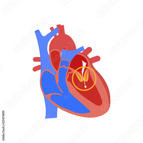 Mitral Stenosis, Cardiovascular Disease Illustration Icon