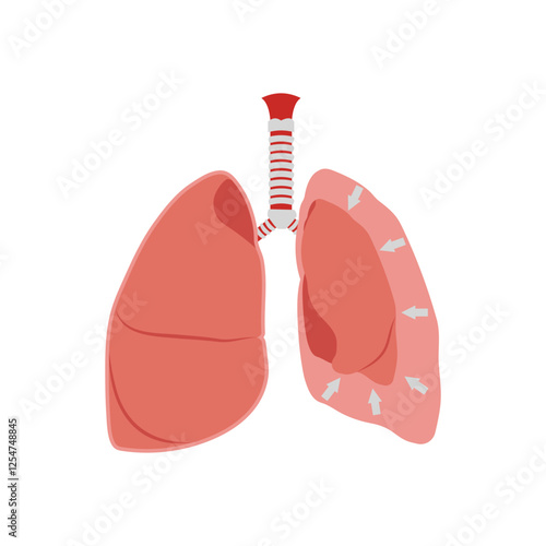 Pleural Effusion, Cardiovascular Disease Illustration Icon