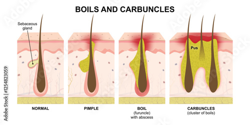 Boils and Carbuncles Skin Infection Illustration
