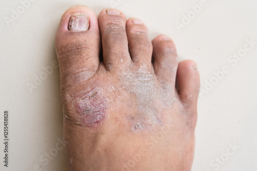 An overhead close-up of a foot with a fungal infection. The skin has red patches, some peeling, and a discolored toenail.