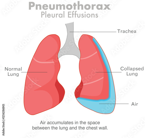 Pneumothorax, air in the lungs or collapsed lung.   Pleural effusions, respiratory system diseases. Vector illustration