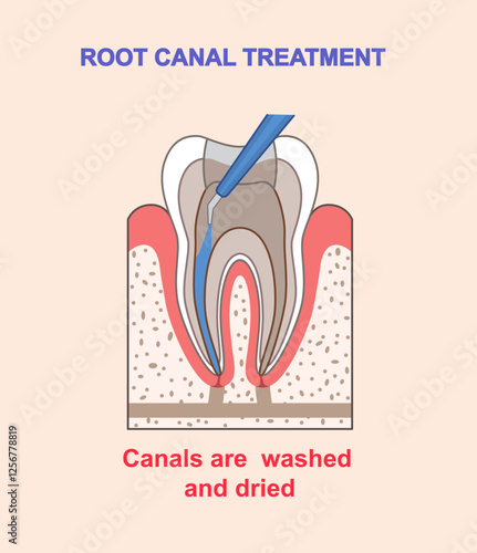 Root canal treatment infographics. Canals washed and dried. Dentistry and stomatology. Healthcare and medicine. Oral hygiene. Flat vector illustration isolated on beige background