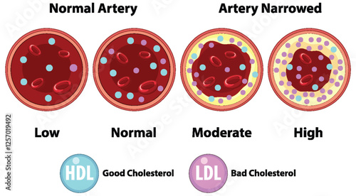 Cholesterol Levels in Arteries Illustration