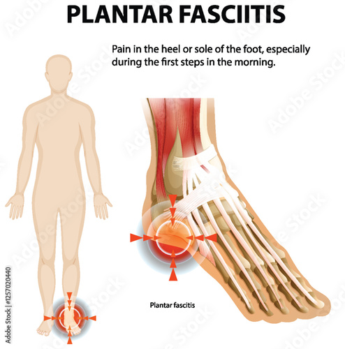 Understanding Plantar Fasciitis and Foot Pain