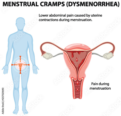 Understanding Menstrual Cramps and Dysmenorrhea