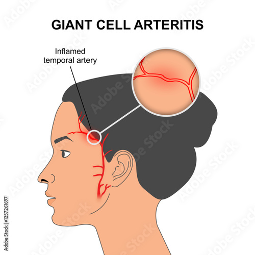 Giant Cell Arteritis (Temporal Arteritis) Illustration