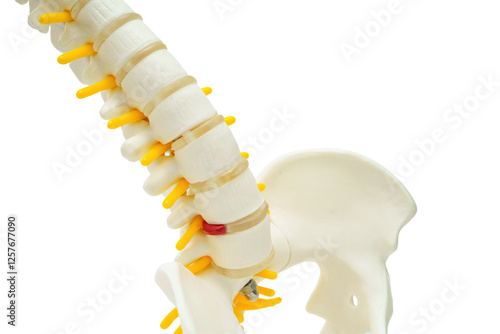Spinal nerve and bone, Lumbar spine displaced herniated disc fragment, Model for treatment medical in the orthopedic department.