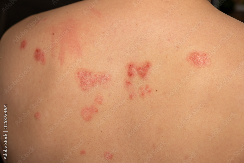 Skin patches affected by psoriasis display red, itchy, and scaly texture on the back of an individual in a clinical setting Skin patches affected by psoriasis display red, itchy, and scaly texture on the back of an individual in a clinical setting