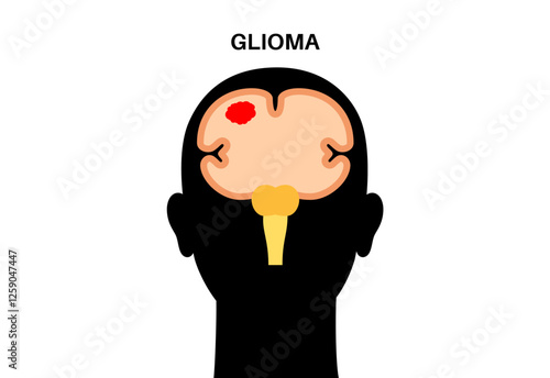 Glioma brain cancer