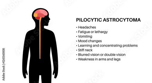 Pilocytic astrocytoma poster