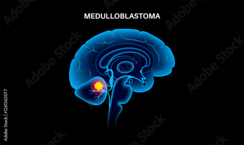 Medulloblastoma brain cancer