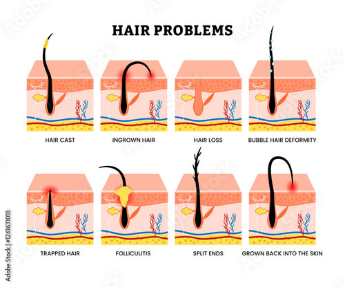 Set of hair problem collection infographic for education poster with hair cast, ingrown, hair loss, bubble hair deformity, trapped, folliculitis, split ends, grown back into the skin, dermatology.