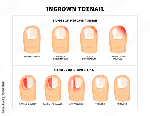 Set different types of ingrown toenail collection with ingrown toenail stages and surgery infographic, partially removed nail , foot disease, infected nail and trimming, isolated on white background.