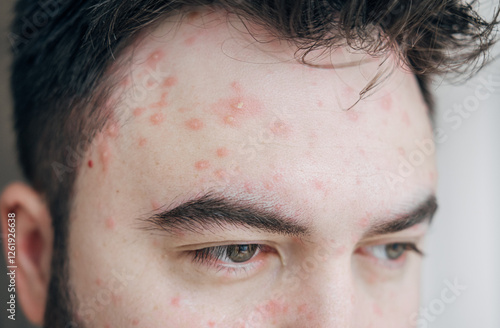 Adult man half face with strong aggressive varicella or chicken pox. Pink spots, papules, vesicles. photo