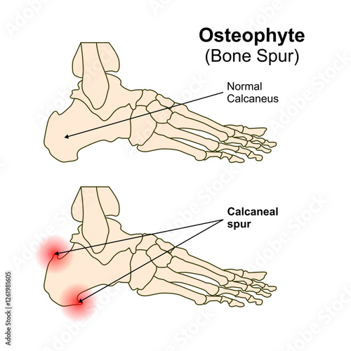 Bone Spur (Osteophyte) Illustration, Heel spur
