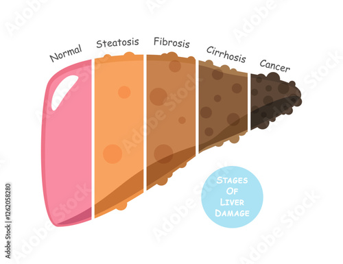 Stages of liver damage include steatosis or fatty liver, fibrosis, cirrhosis and cancer or hepatocellular carcinoma . Flat design . Vector .